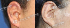 耳廓烧伤的修复方