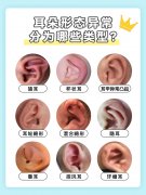 招风耳比较明显的